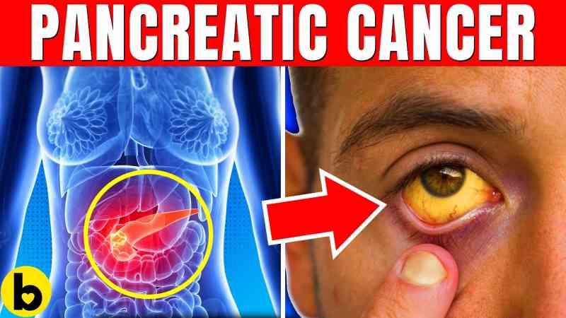 Early Warning Signs Of Pancreatic Cancer You Should Never Ignore 0673